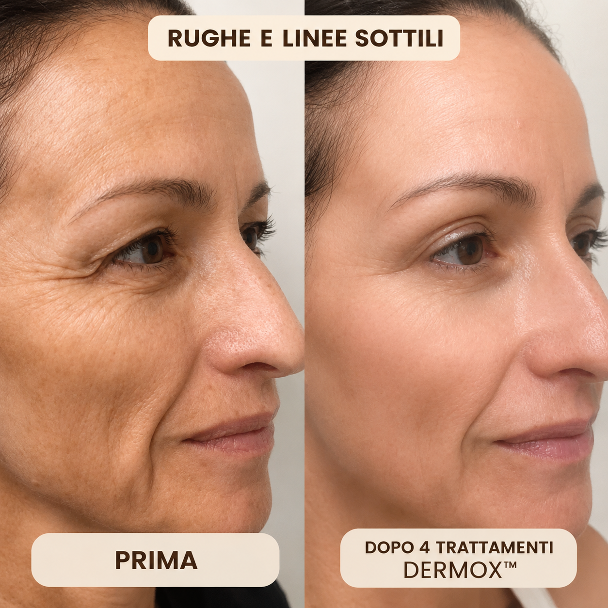 Dermox™ Sistema di Micro-infusione