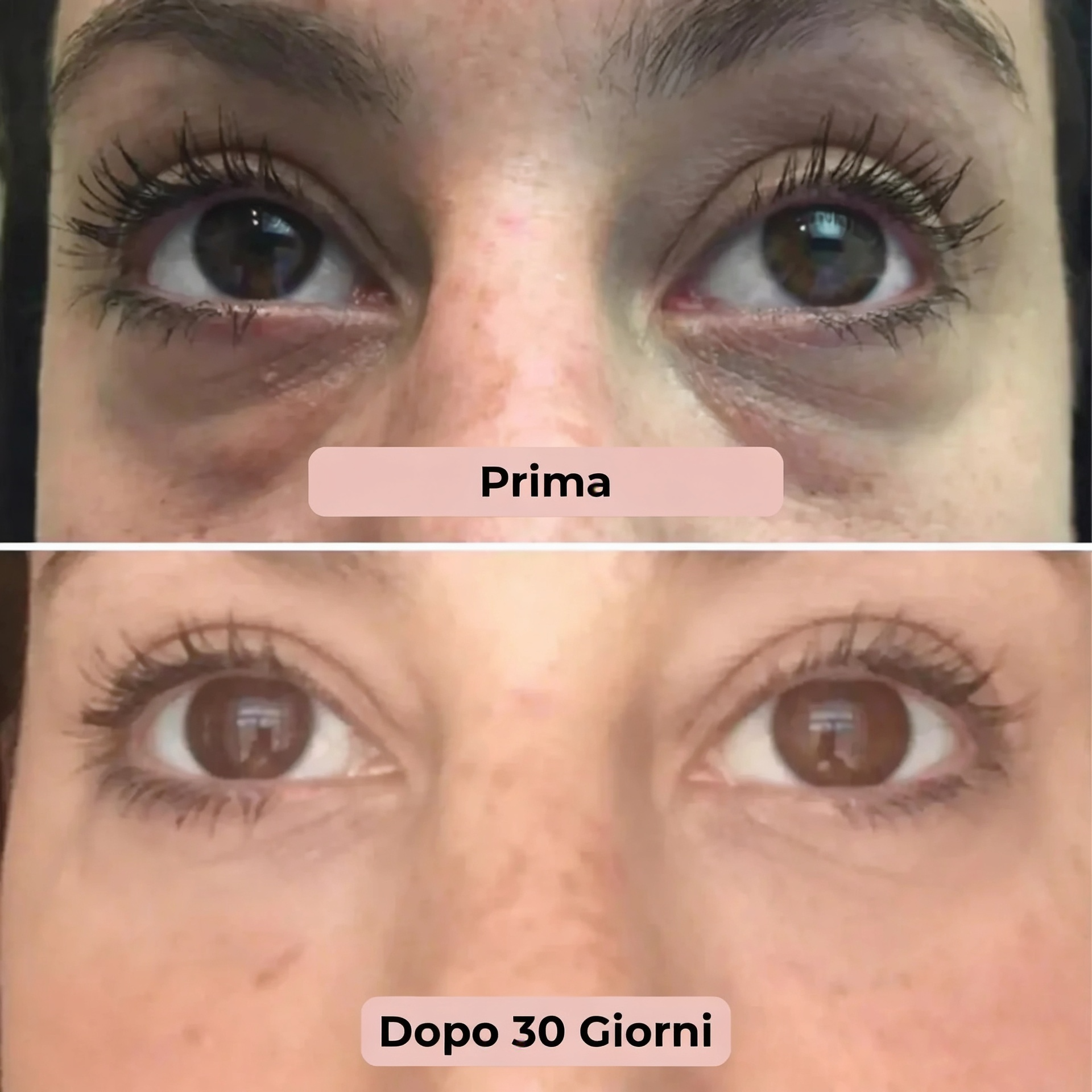 DermaPatch™ Patch per Occhi ai Microneedle